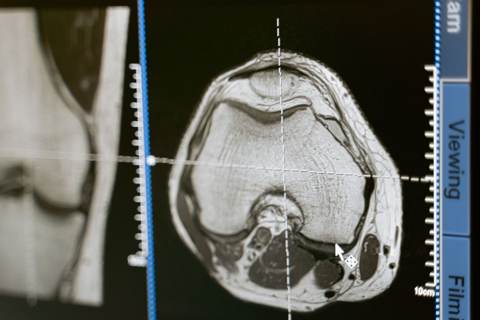 Mesothelioma vs Lung Cancer: Key Differences Explained