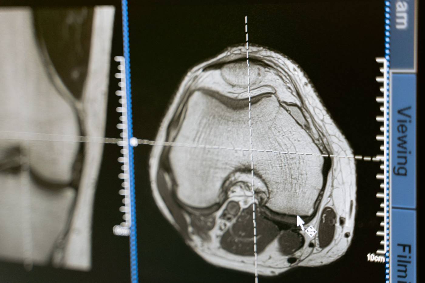 Mesothelioma and lung cancer share some symptoms but differ in origin, cause, and treatment.